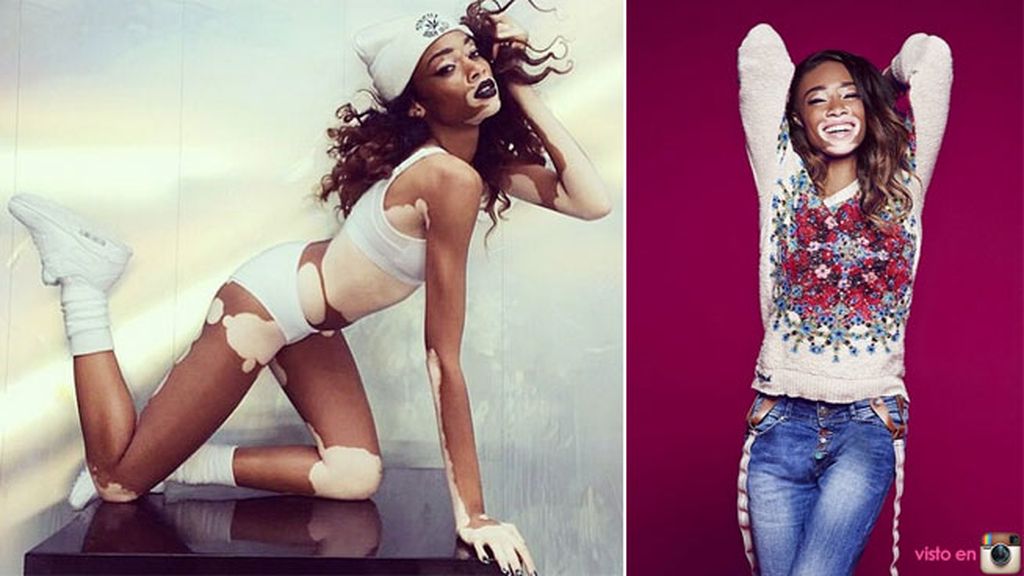 En entrevistas ha confesado que tuvo que luchar con los insultos como cebra o vaca