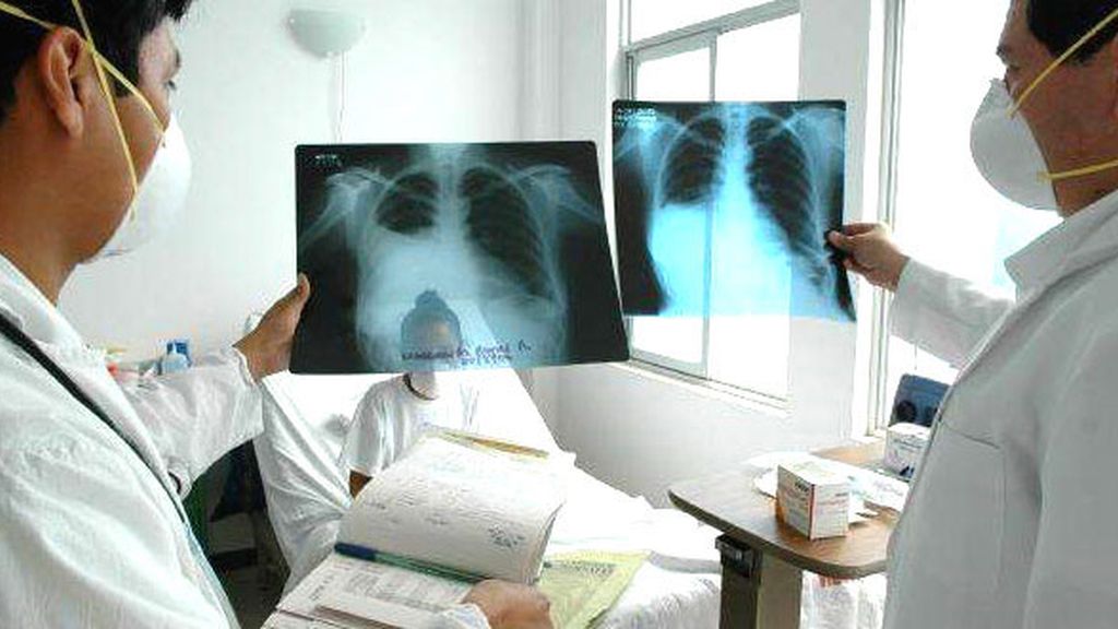 La tuberculosis es una infección bacteriana que afecta a los pulmones La tuberculosis es una infección bacteriana que afecta a los pulmones
