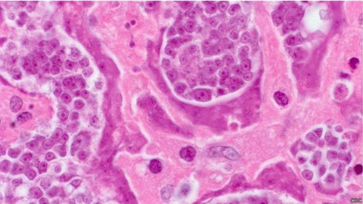 Un gusano intestinal transmite cáncer a un hombre en Colombia