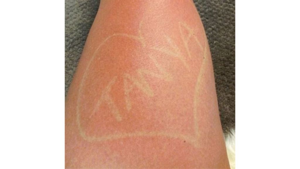 Sunburn Art, el arte de quemarse al sol