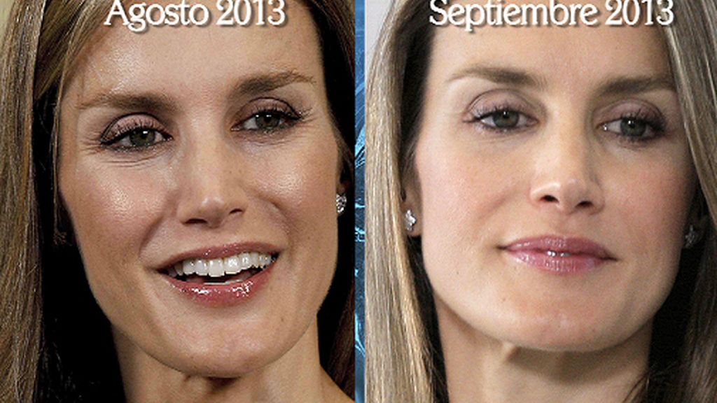 Las fotos del antes y el después de las operaciones estéticas de Letizia Ortiz