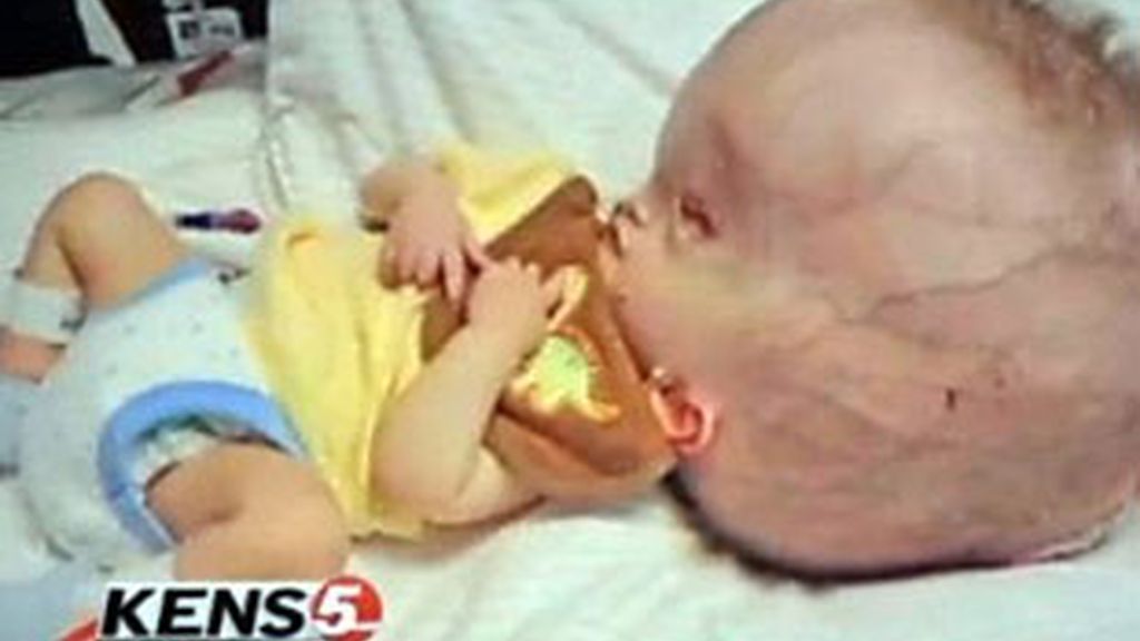 Klaus tiene su pequeño cerebro lleno de líquido. Foto: Daily Mail