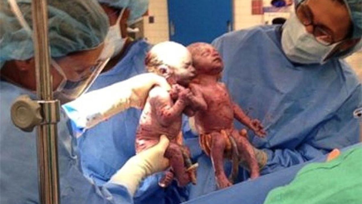 gemelos, Jillian y Jenna, Akron General Medical Center, nacidos de la mano