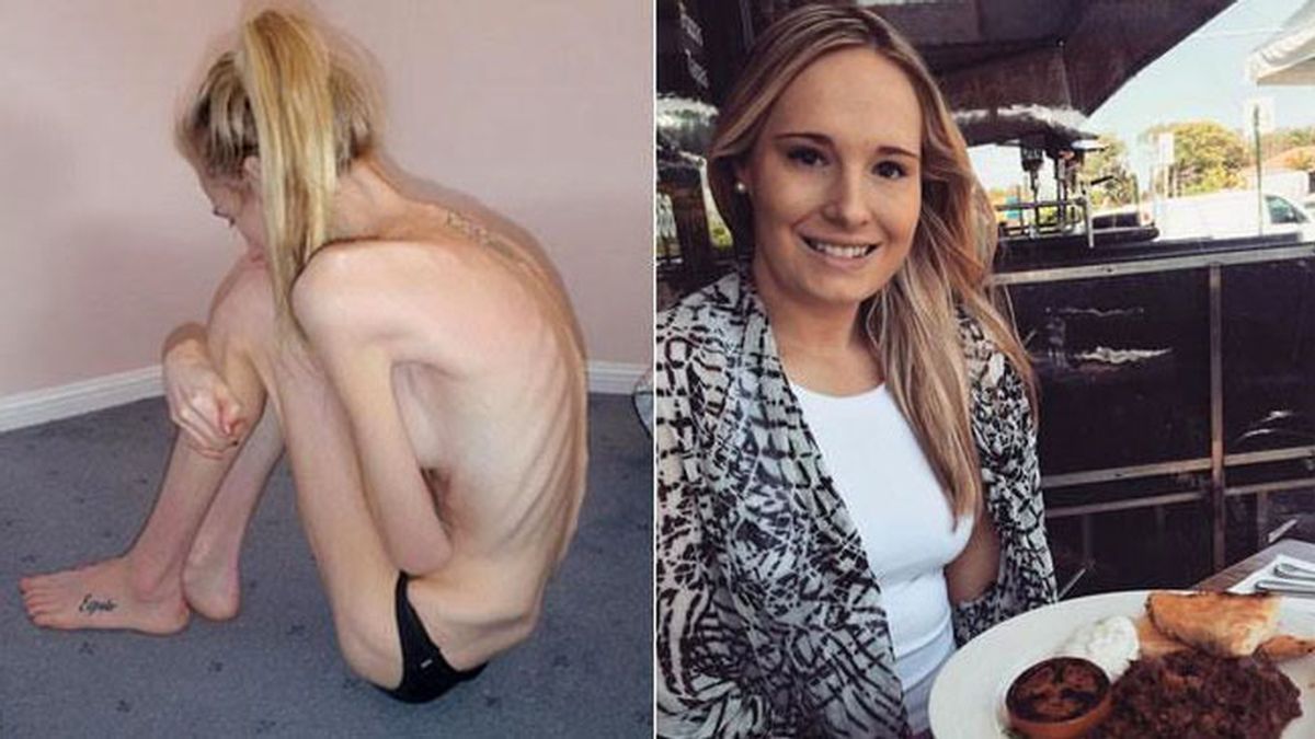 anorexia, Gemma Walker,  desorden alimentario