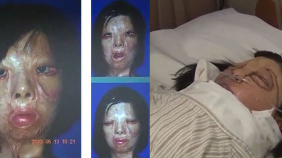 adolescente china,trasplante de cara,Xu Jianmei,desfigurada,