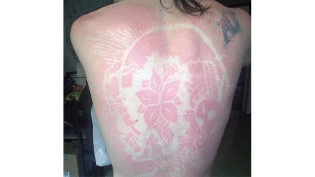 Sunburn Art, el arte de quemarse al sol