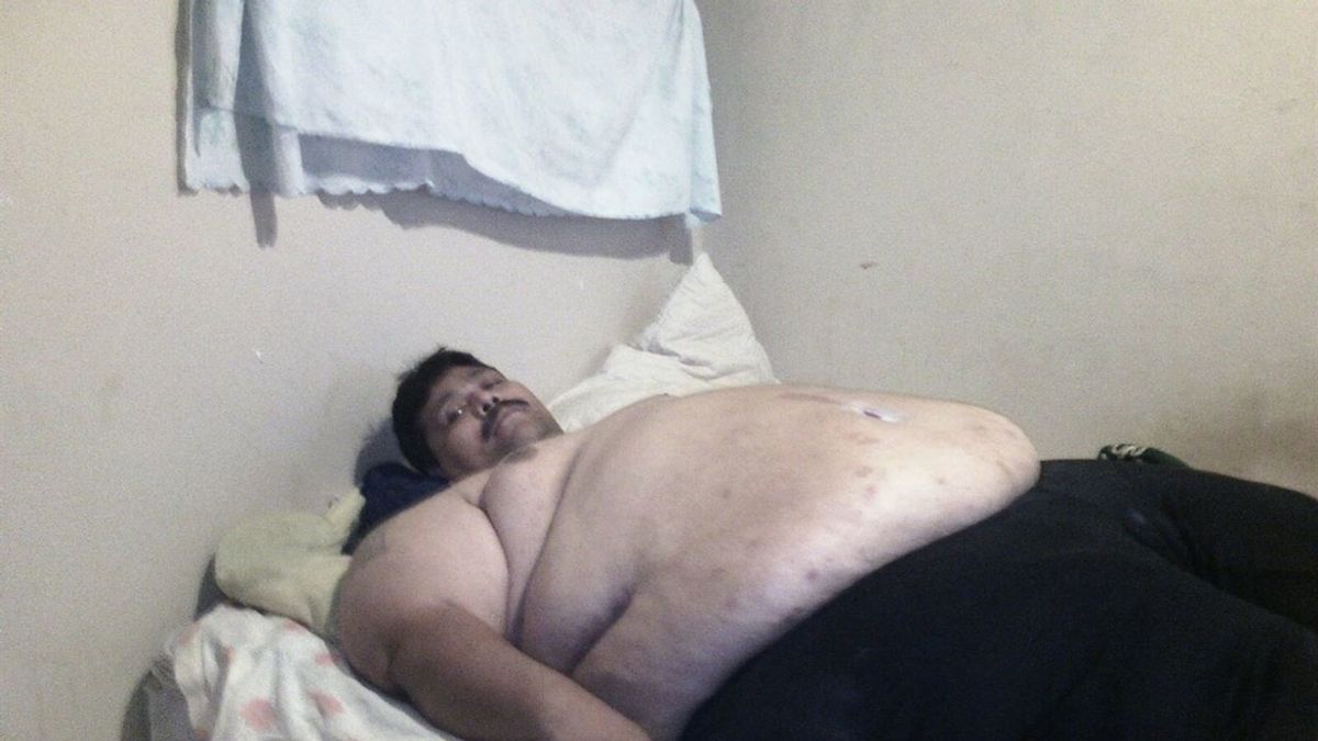 El hombre más obeso del mundo, pendiente de una operación que le salve la vida