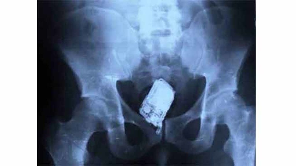Objetos inesperados dentro del cuerpo