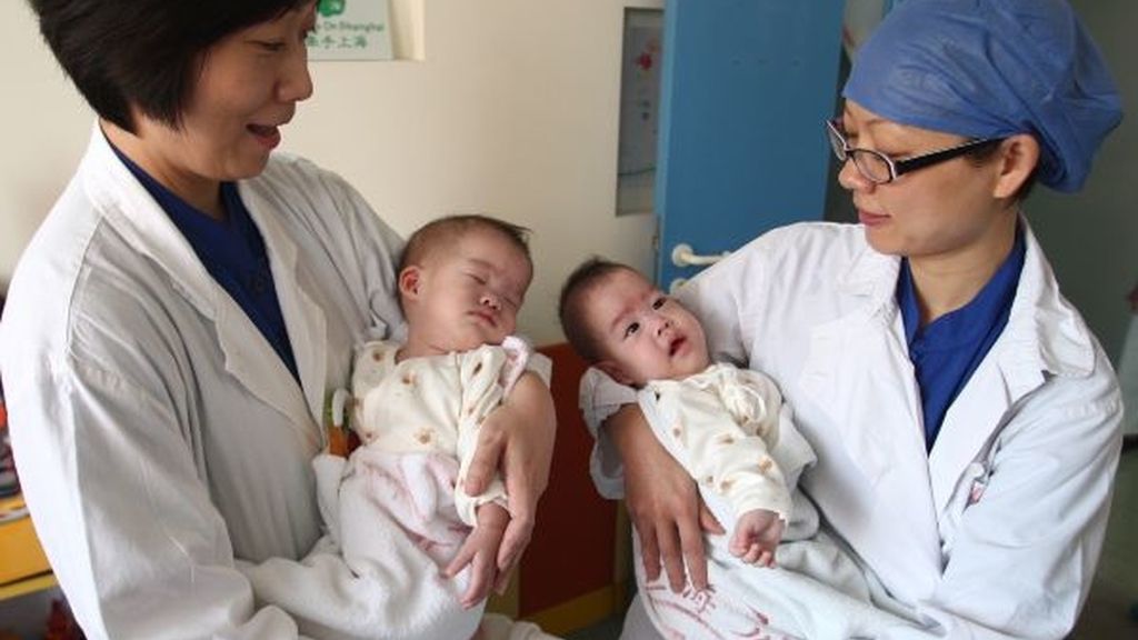 Separan con éxito a dos siamesas chinas unidas por el tronco