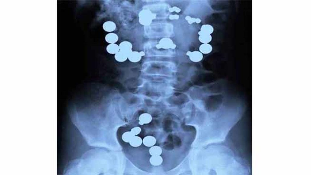 Objetos inesperados dentro del cuerpo