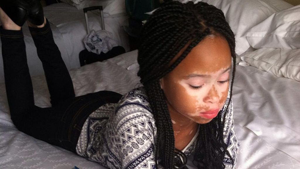 La niña con vitiligo que ha revolucionado las redes sociales