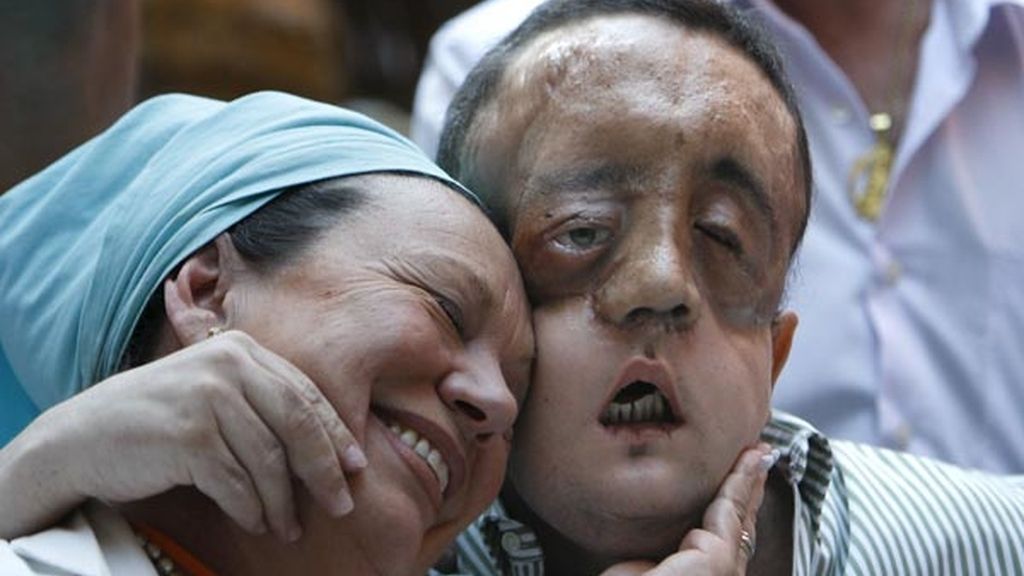 Rafael, el primer trasplantado de cara en España que muestra su rostro