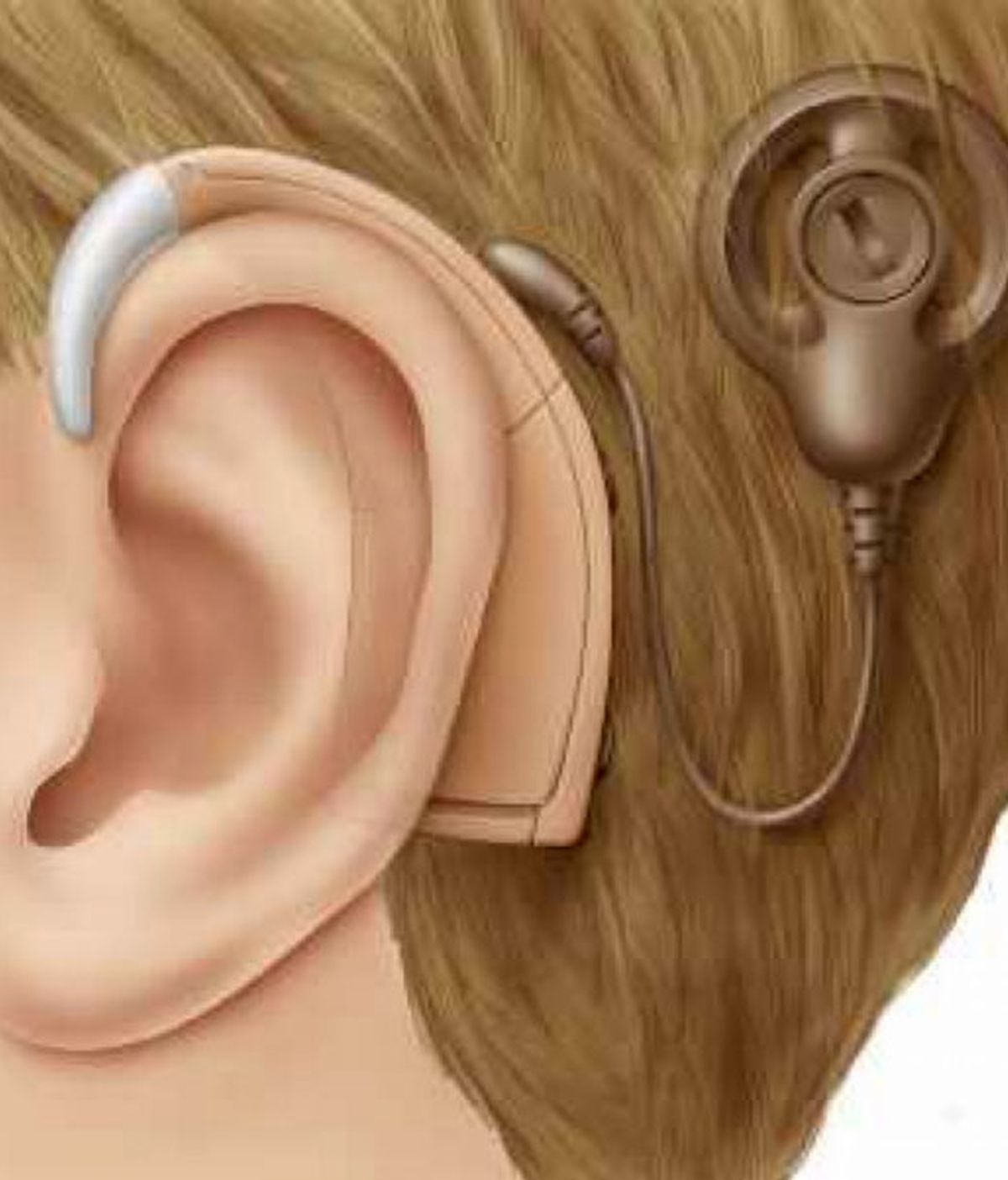 aparato sordo, implante coclear, sordos