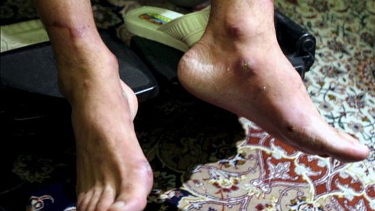 Primer plano de los pies del diplomático iraní Yalal Sharafi durante una rueda de prensa en Teherán (Irán). Sharafi, secuestrado en Irak y liberado el 3 de abril de 2007, afirmó haber sufrido "torturas terroríficas por parte de los agentes de la CIA" que, según él, le capturaron en Bagdad, entre ellas la perforación de sus pies con un taladro. EFE/Archivo