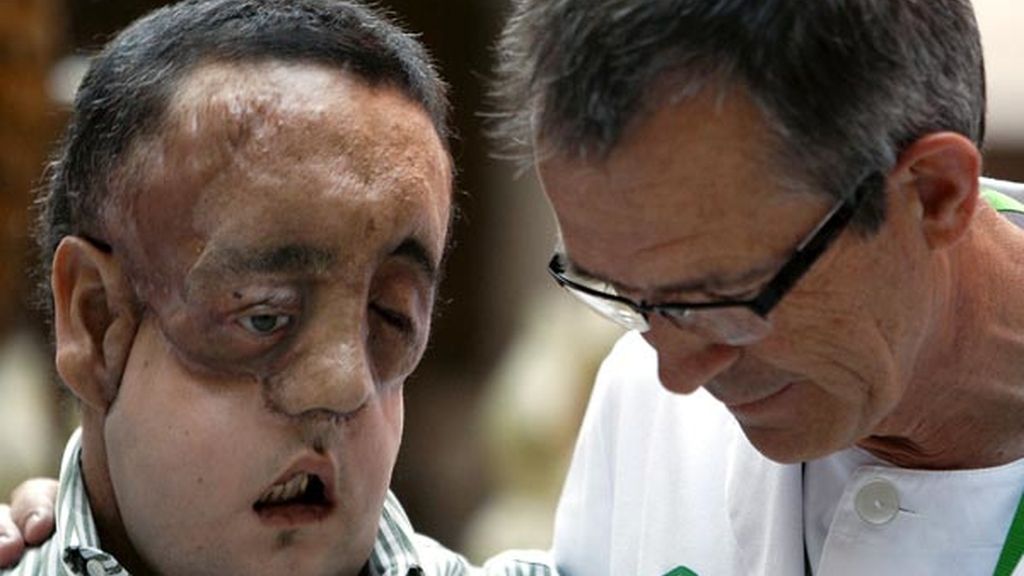 Rafael, el primer trasplantado de cara en España que muestra su rostro