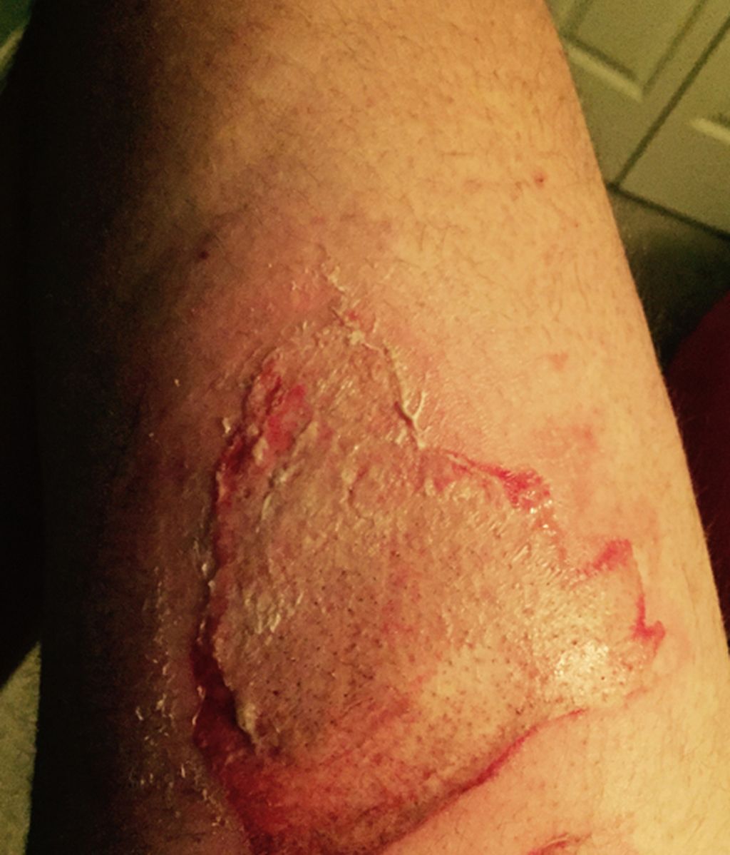 Un iPhone 6 arde y causa quemaduras de segundo grado