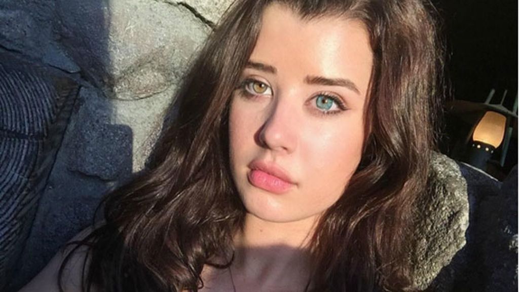 Nació con heterochromia iridum