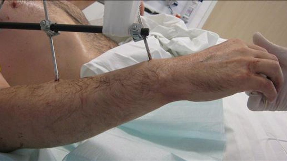 En la imagen, un paciente tras un trasplante de brazos. EFE/A