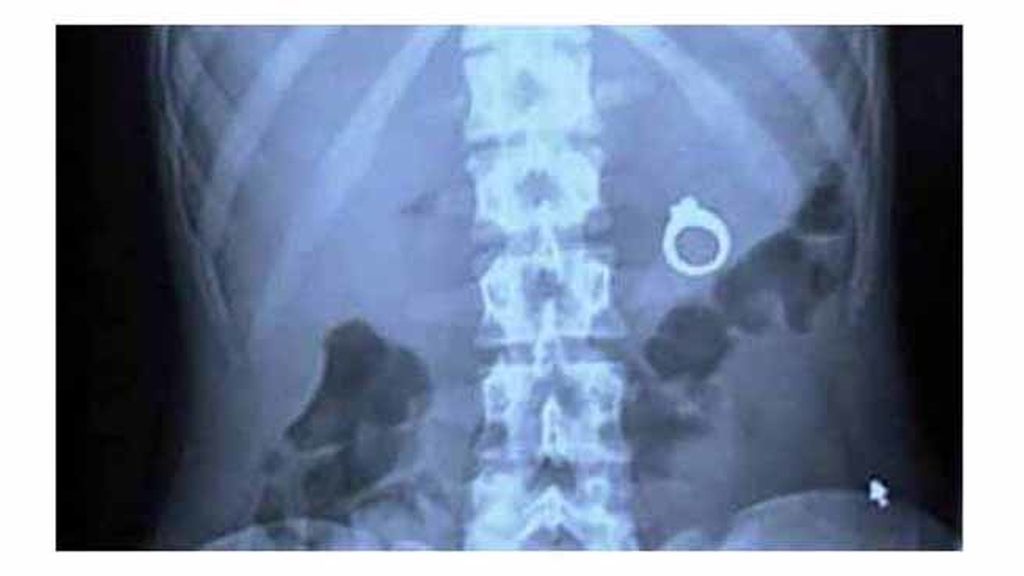 Objetos inesperados dentro del cuerpo