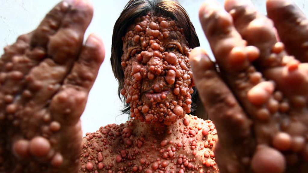 Vivir con el cuerpo cubierto de tumores