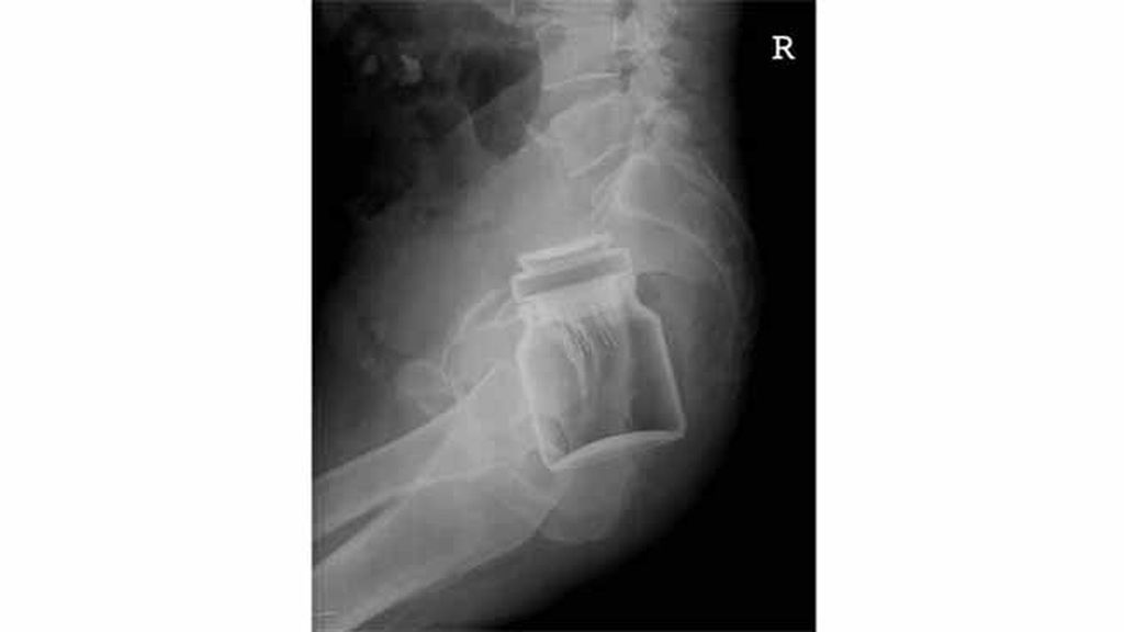 Objetos inesperados dentro del cuerpo