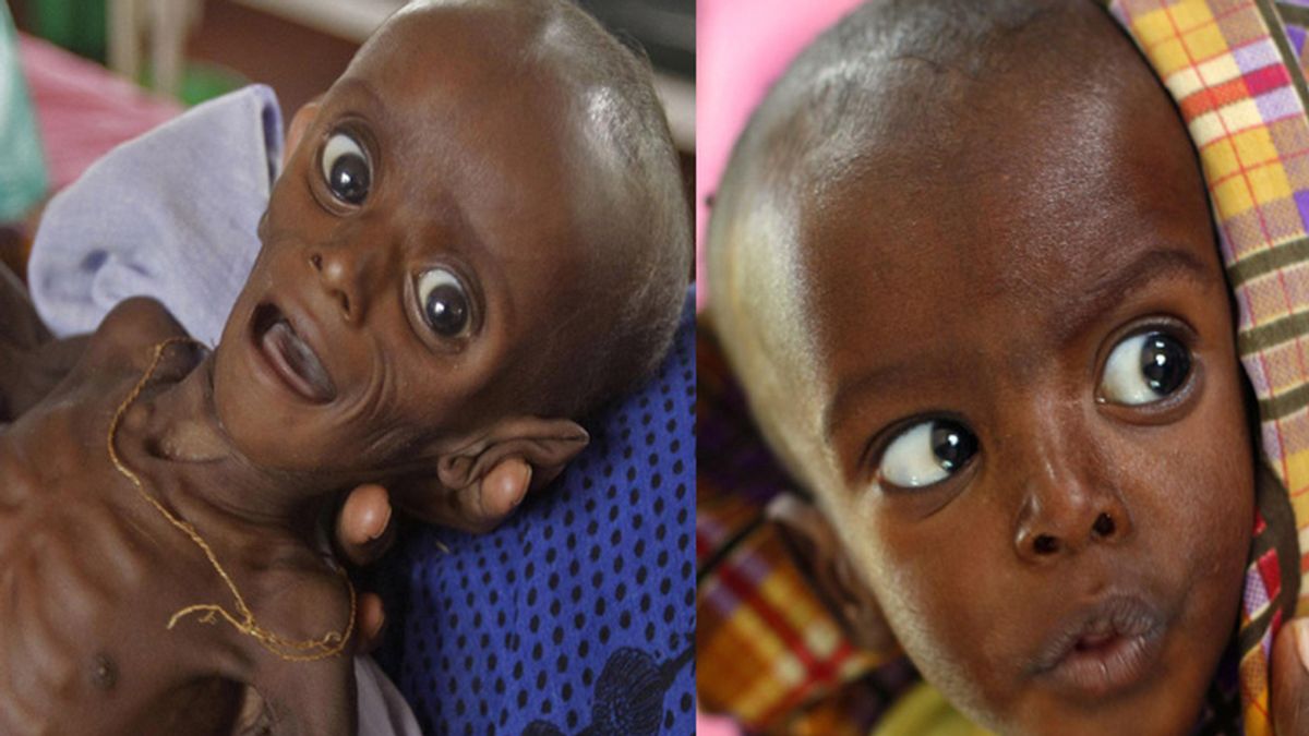 El bebé Minhaj Gedi Farah fue salvado de morir de hambre en un campamento de la ONU en Kenia para refugiados somalíes.