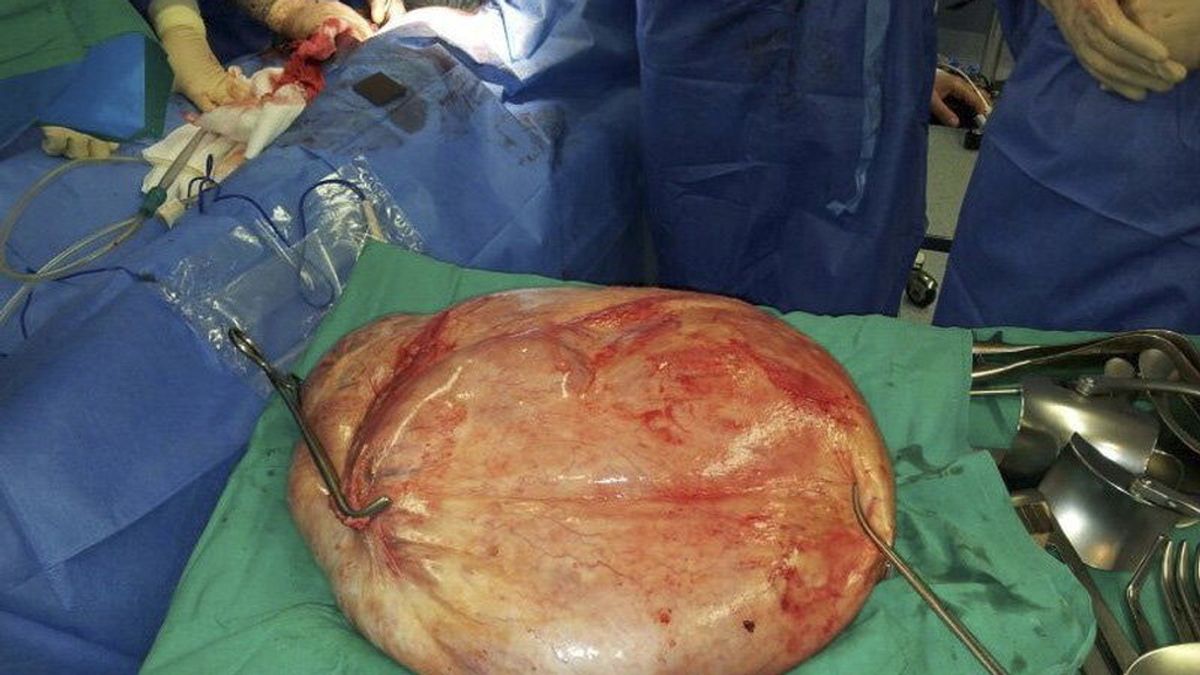 Extraen con éxito un tumor de 25 kilos en el hospital de Torrevieja Extraen con éxito un tumor de 25 kilos en el hospital de Torrevieja