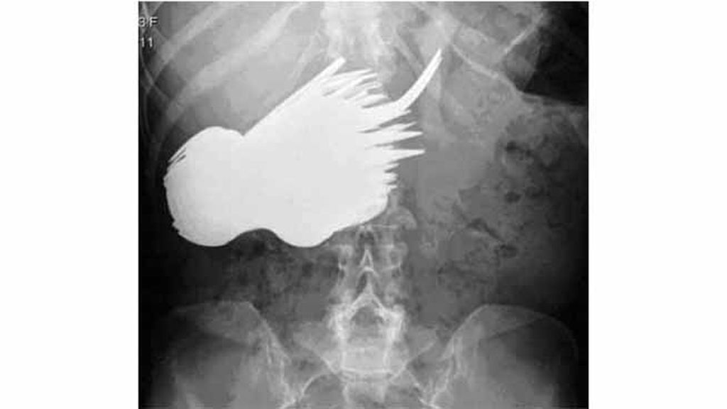 Objetos inesperados dentro del cuerpo
