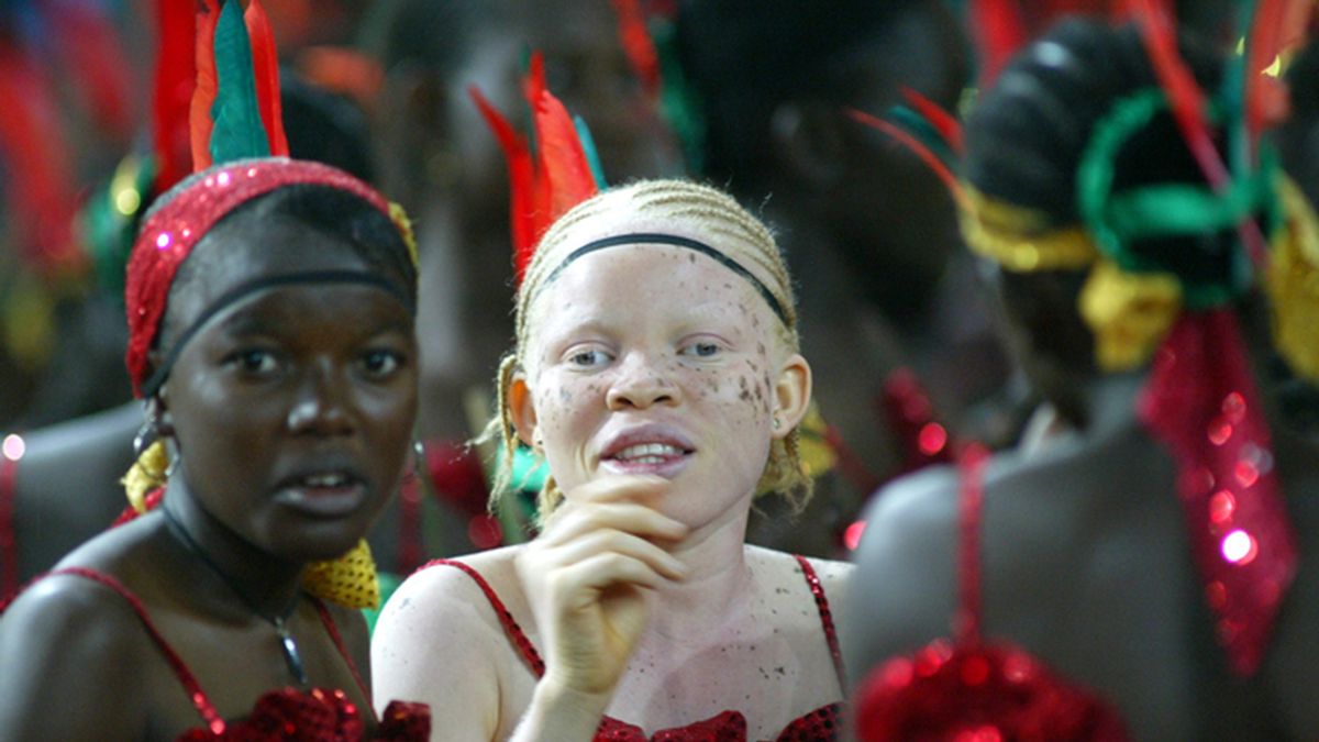 Adolescente nigeriana albina