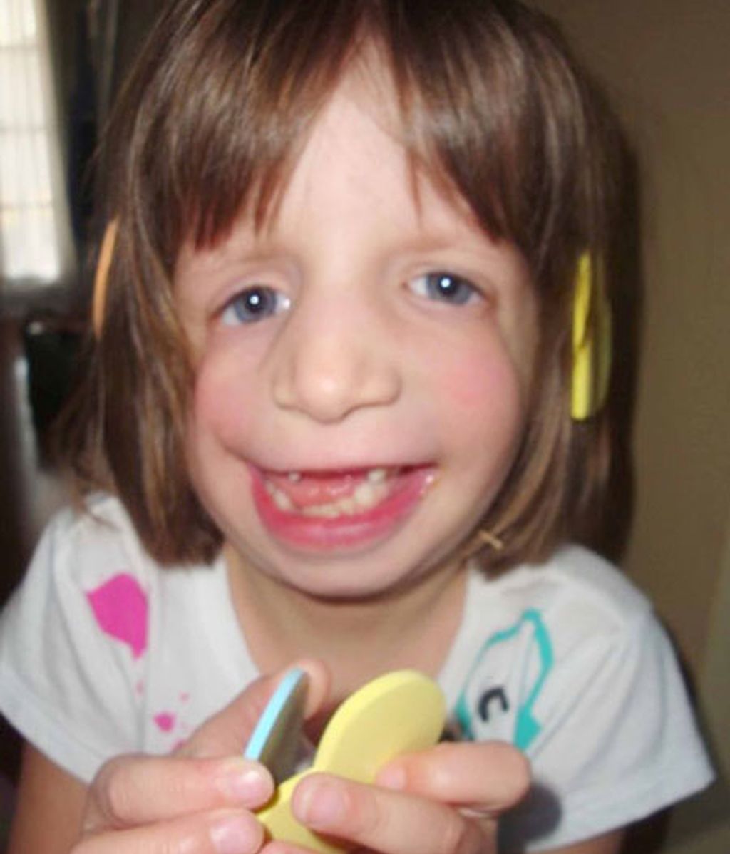 Sin cara por una malformación genética