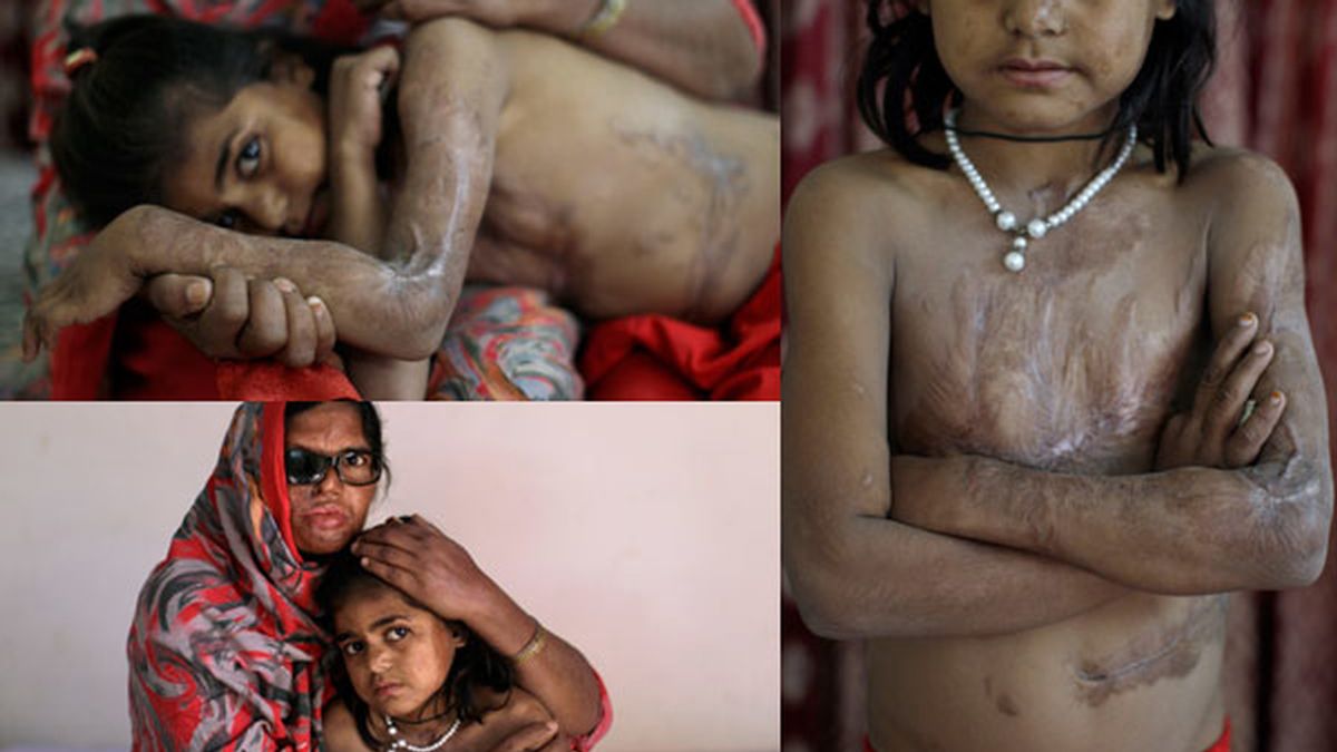 Niña pakistaní quemada con ácido por su padre