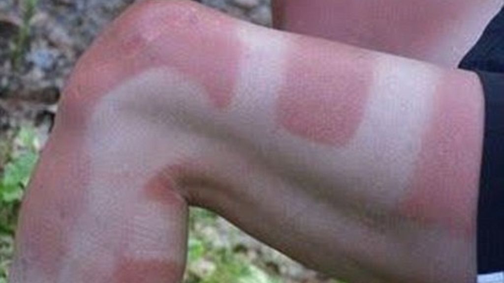 Los rayos UVA y el sol dañan la salud