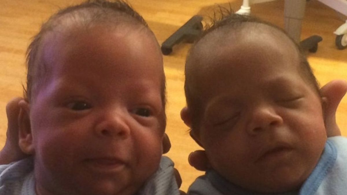 Unos gemelos nacen con 24 días de diferencia