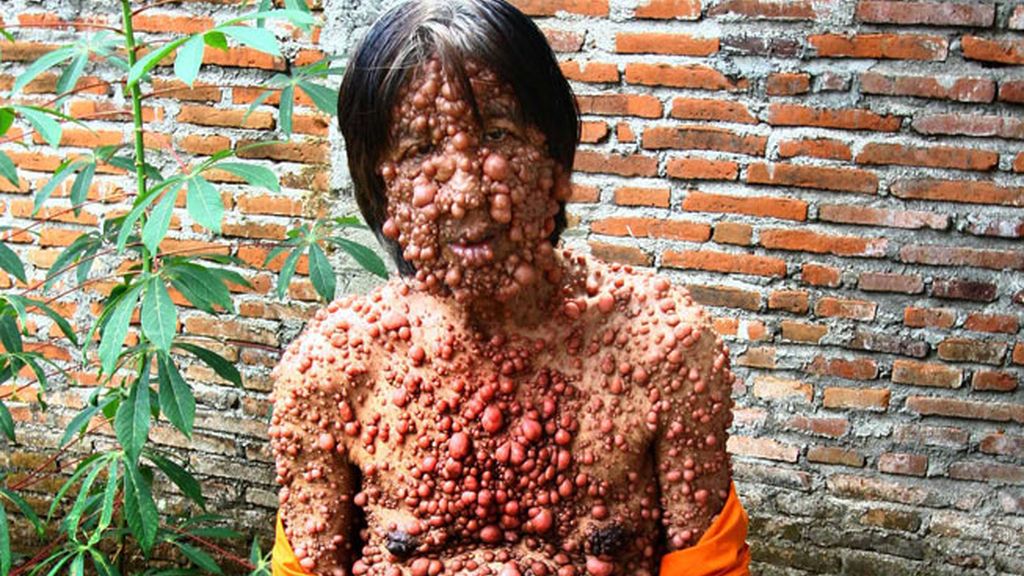 Vivir con el cuerpo cubierto de tumores