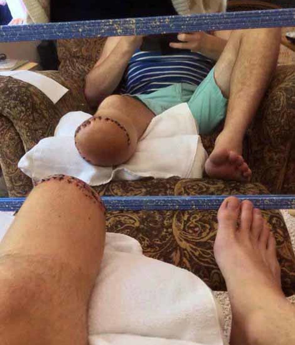 Decide amputarse la pierna para poder seguir haciendo deporte