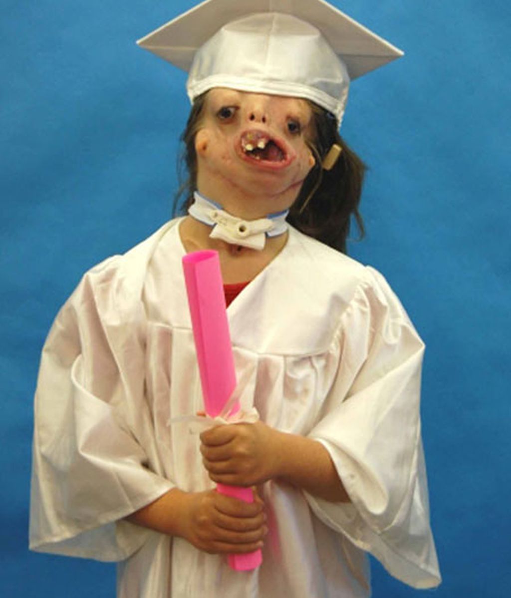 Sin cara por una malformación genética