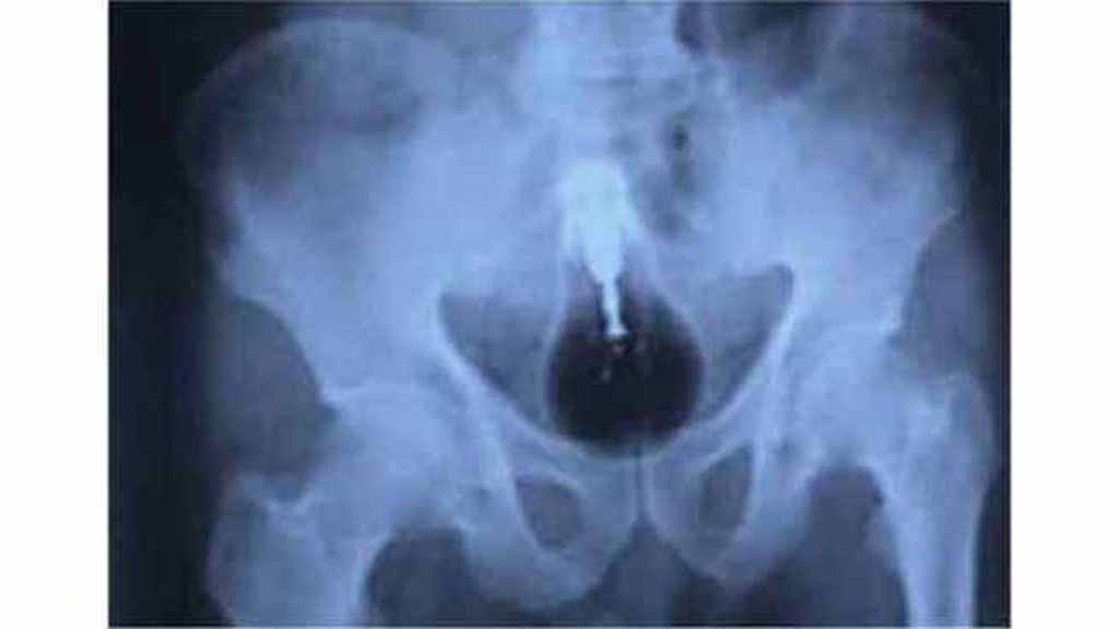Objetos inesperados dentro del cuerpo