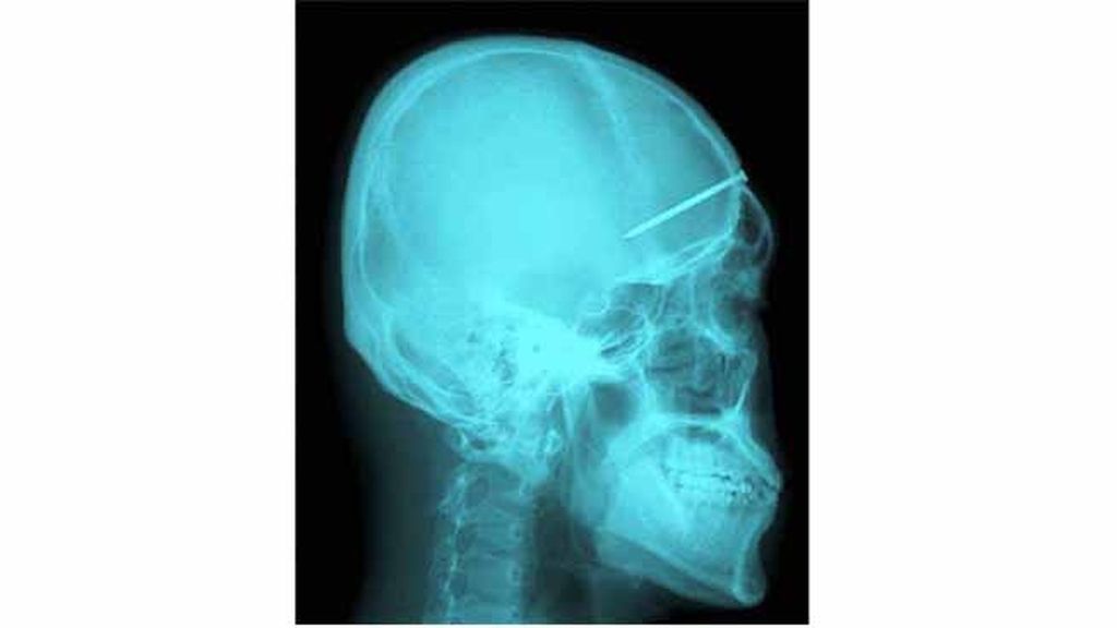 Objetos inesperados dentro del cuerpo