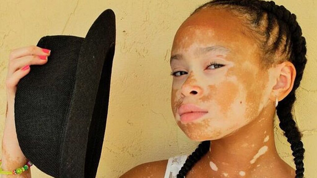 La niña con vitiligo que ha revolucionado las redes sociales