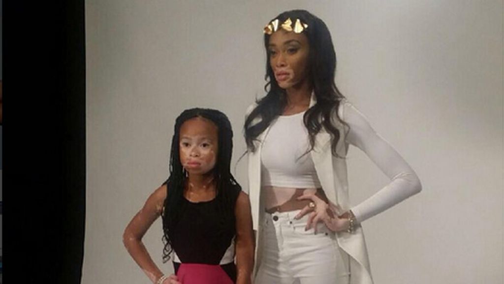 La niña con vitiligo que ha revolucionado las redes sociales