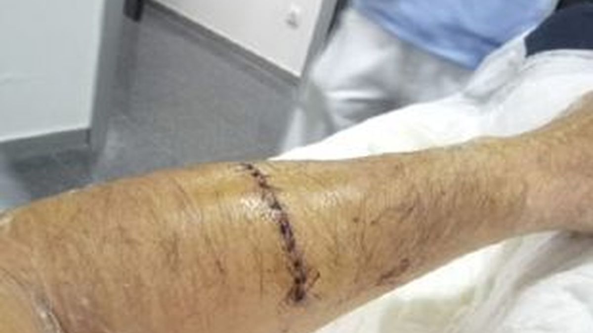 Imagen del brazo de un abogado madrileño, Nacho Rocha, de 33 años, que ha sufrido una semiamputación tras recibir un machetazo. Foto: EFE