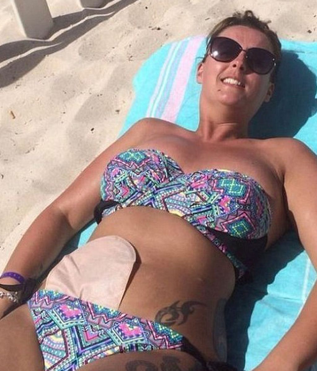 Cientos de enfermos de Crohn dejan de esconder sus fotos de resíduos gracias a la iniciativa de una modelo