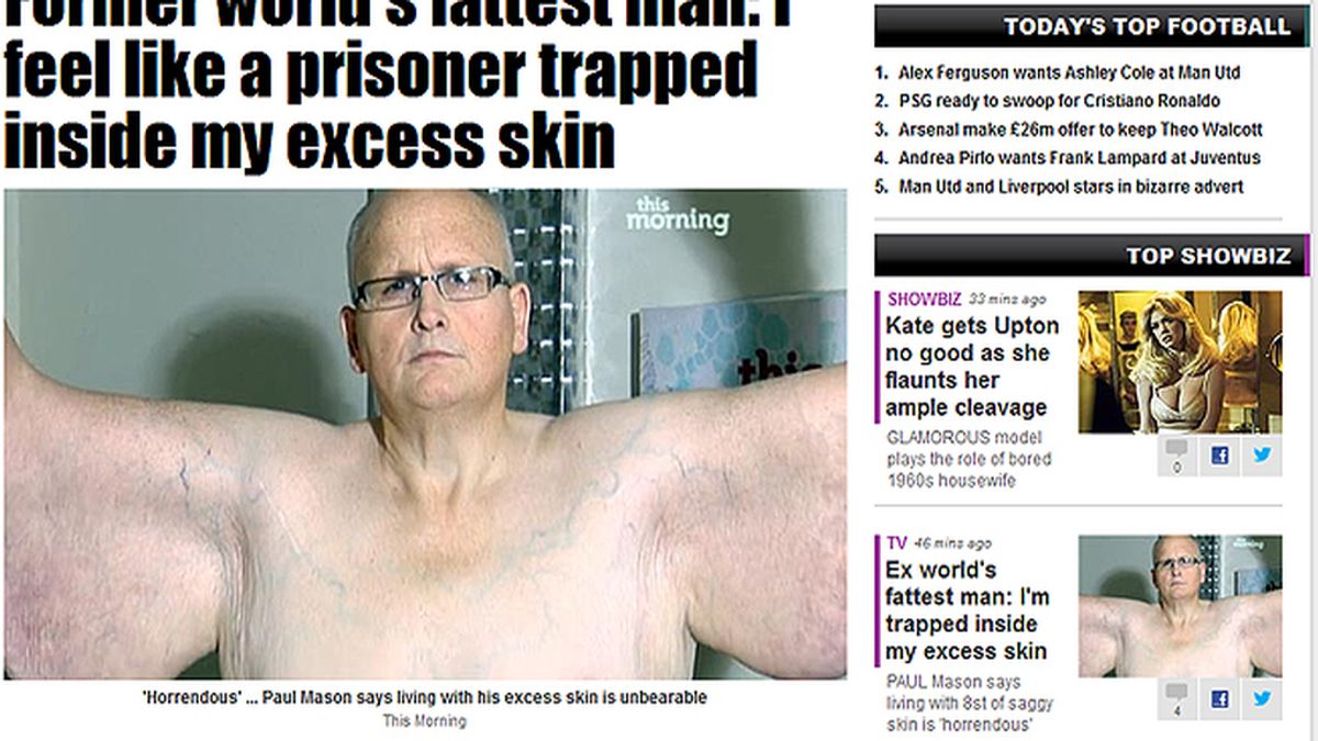 Paul Mason se queja del exceso de piel que le ha quedado tras adelgazar 285 kilos
