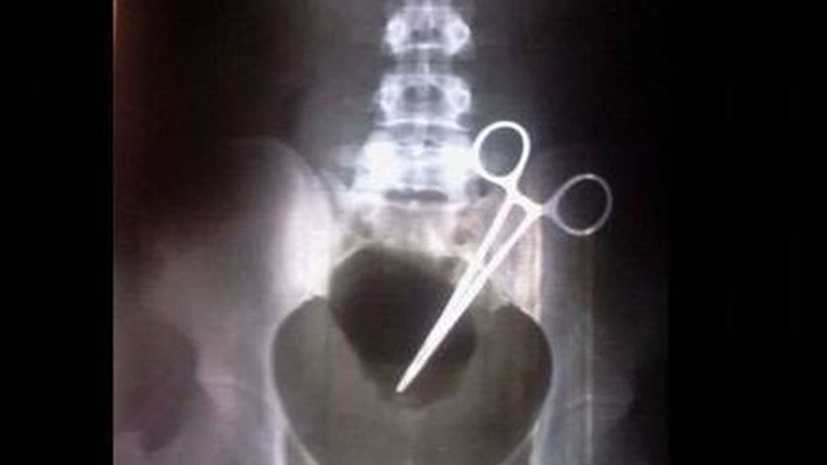 Olvidan unas pinzas en el interior de una mujer al practicarle una cesárea Olvidan unas pinzas en el interior de una mujer al practicarle una cesárea