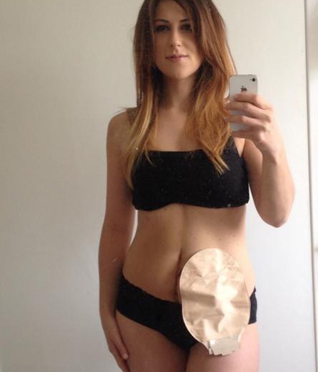 Cientos de enfermos de Crohn dejan de esconder sus fotos de resíduos gracias a la iniciativa de una modelo