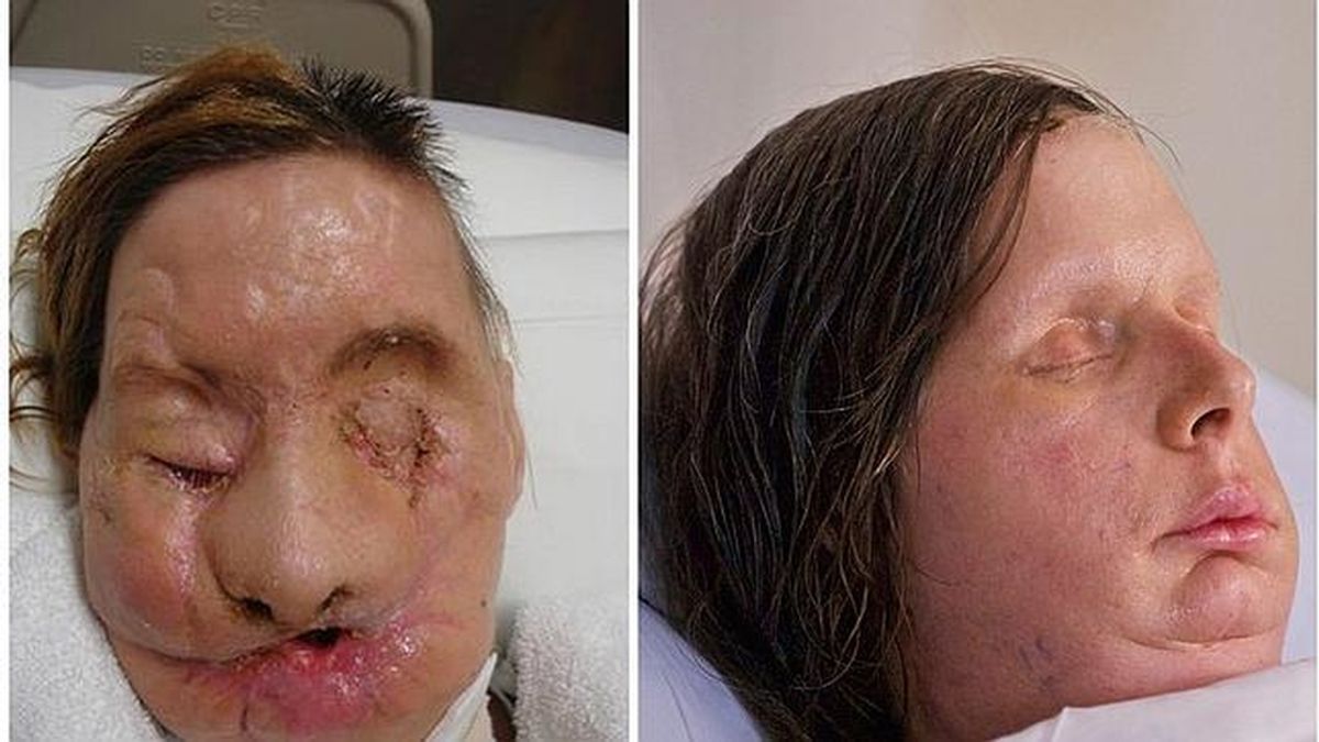 Charla Nash, la mujer atacada por un chimpancé, cada vez más cómoda con su nueva cara Charla Nash, la mujer atacada por un chimpancé, cada vez más cómoda con su nueva cara