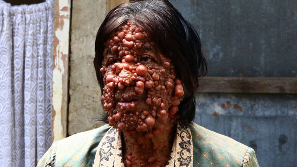 Vivir con el cuerpo cubierto de tumores