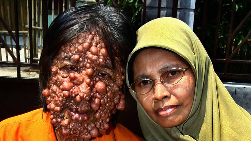 Vivir con el cuerpo cubierto de tumores