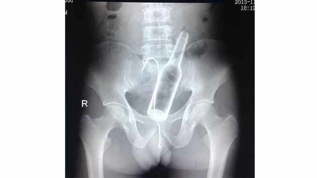 Objetos inesperados dentro del cuerpo