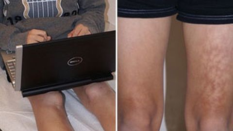 papel Mordrin extraer Síndrome de la piel tostada': Los peligros de colocar el portátil sobre las  piernas
